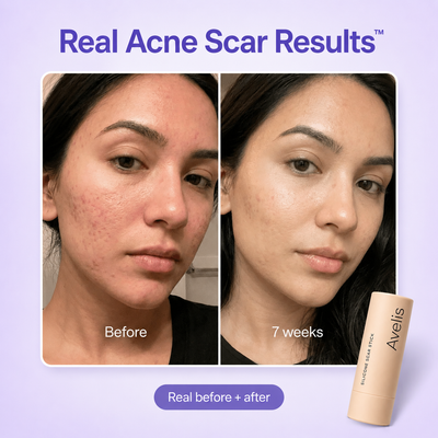 Avelis™ Silicone Scar Stick