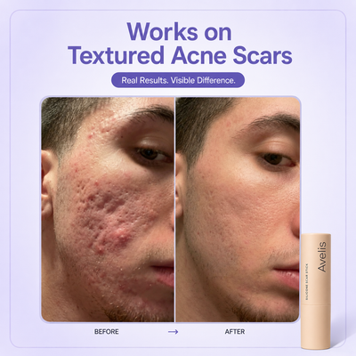Avelis™ Silicone Scar Stick